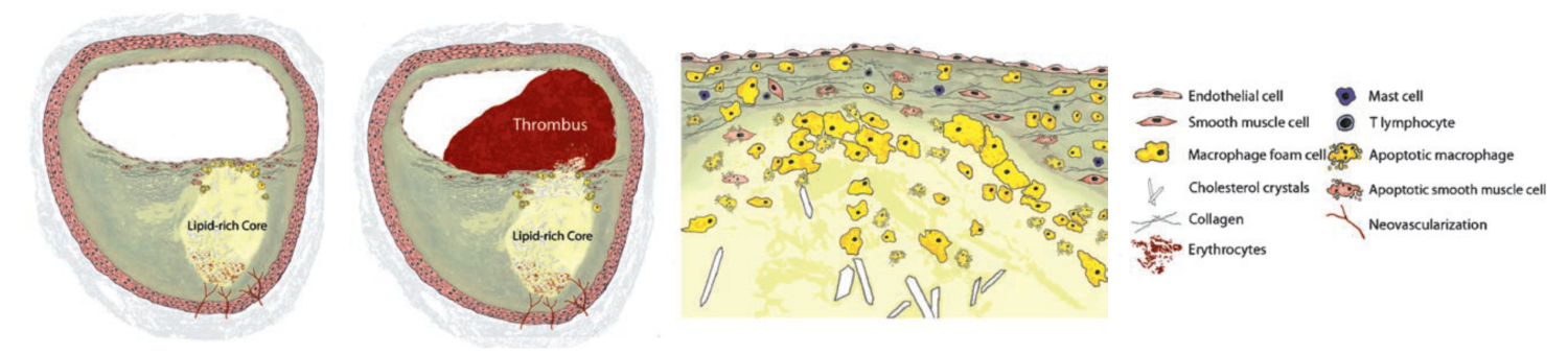 schematic of Type VI lesion