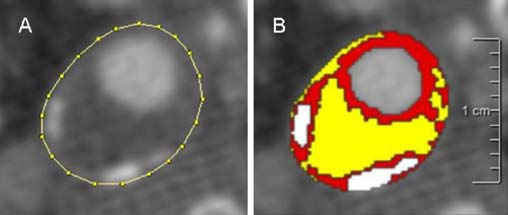 CT image of atherosclerotic plaque in carotid artery.